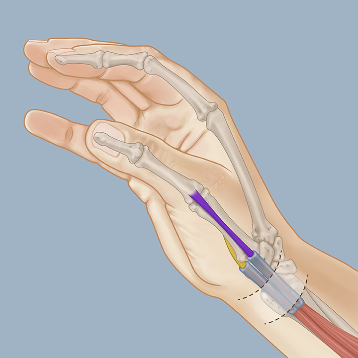 De Quervain S Syndrome Surgery CKSY